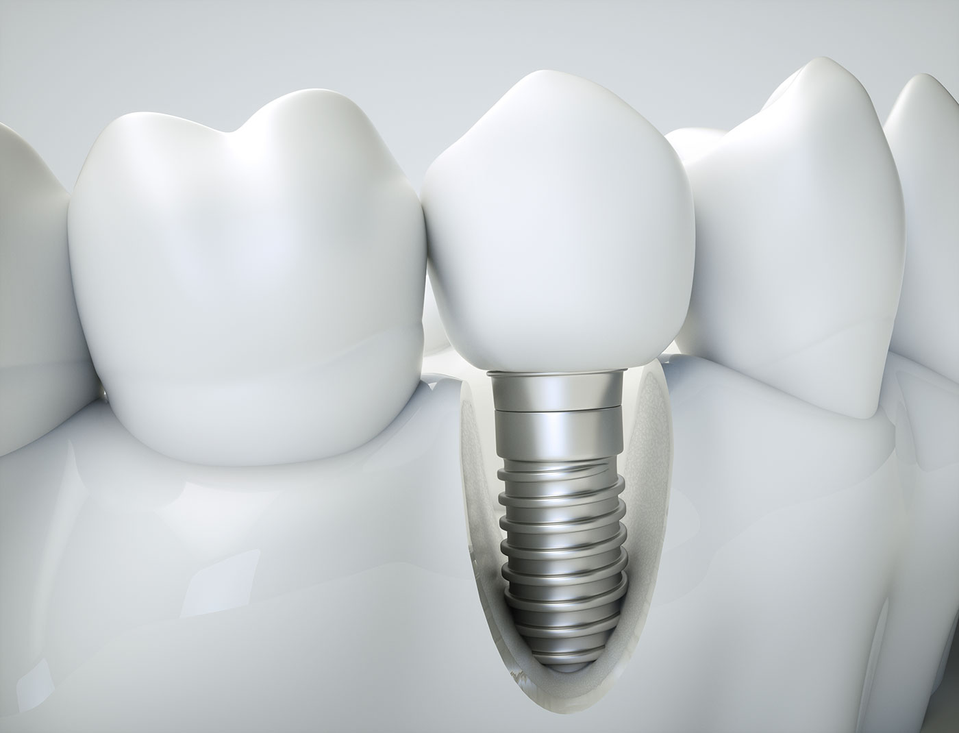 Brampton Dental Implants