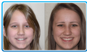 Braces Before After 4-min